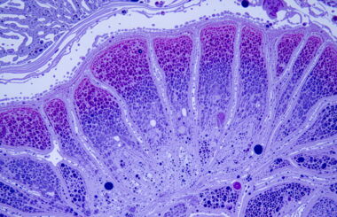 Pathologie, Ärzte, PACS, LABBOARD, Pathologie-Cockpit, Querschnitt Tumor
